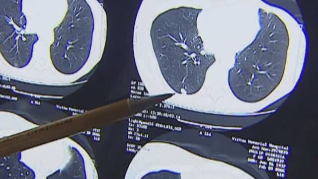 Cancer screenings